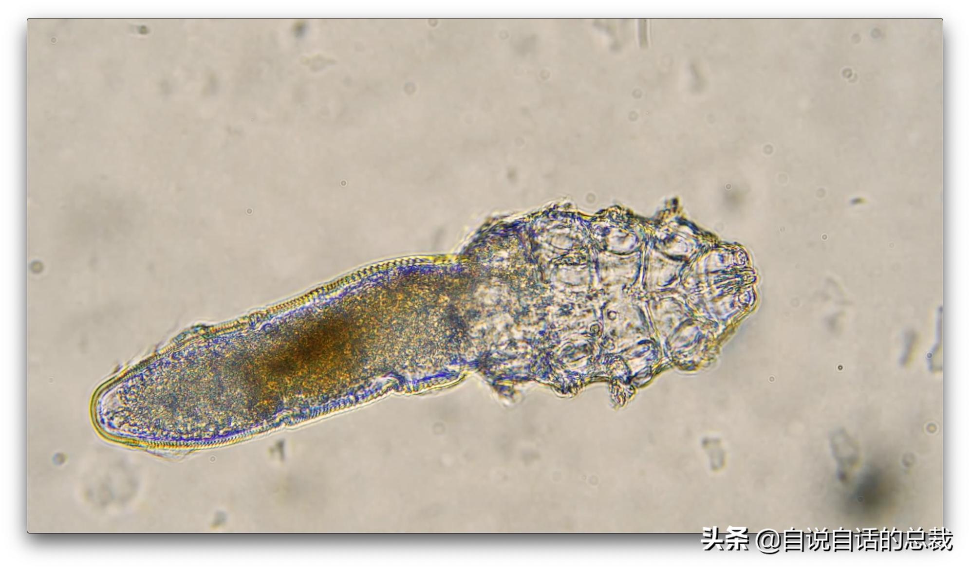 毛囊异型,毛囊里的异形物