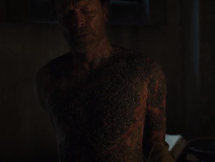 《权力的游戏》：可怕的灰鳞病