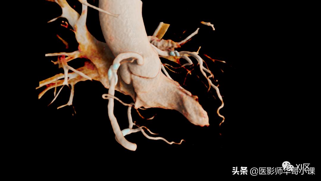 做完碘131检查后注意事项,碘造影剂的作用及使用