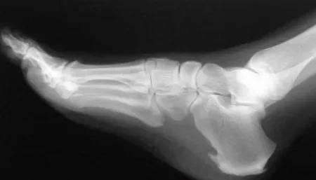 脚跟痛不要再让骨刺背黑锅了,足跟骨刺痛一招教你解决