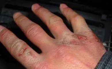 冻疮如何保暖,冬天到了手冻了治疗冻疮的偏方