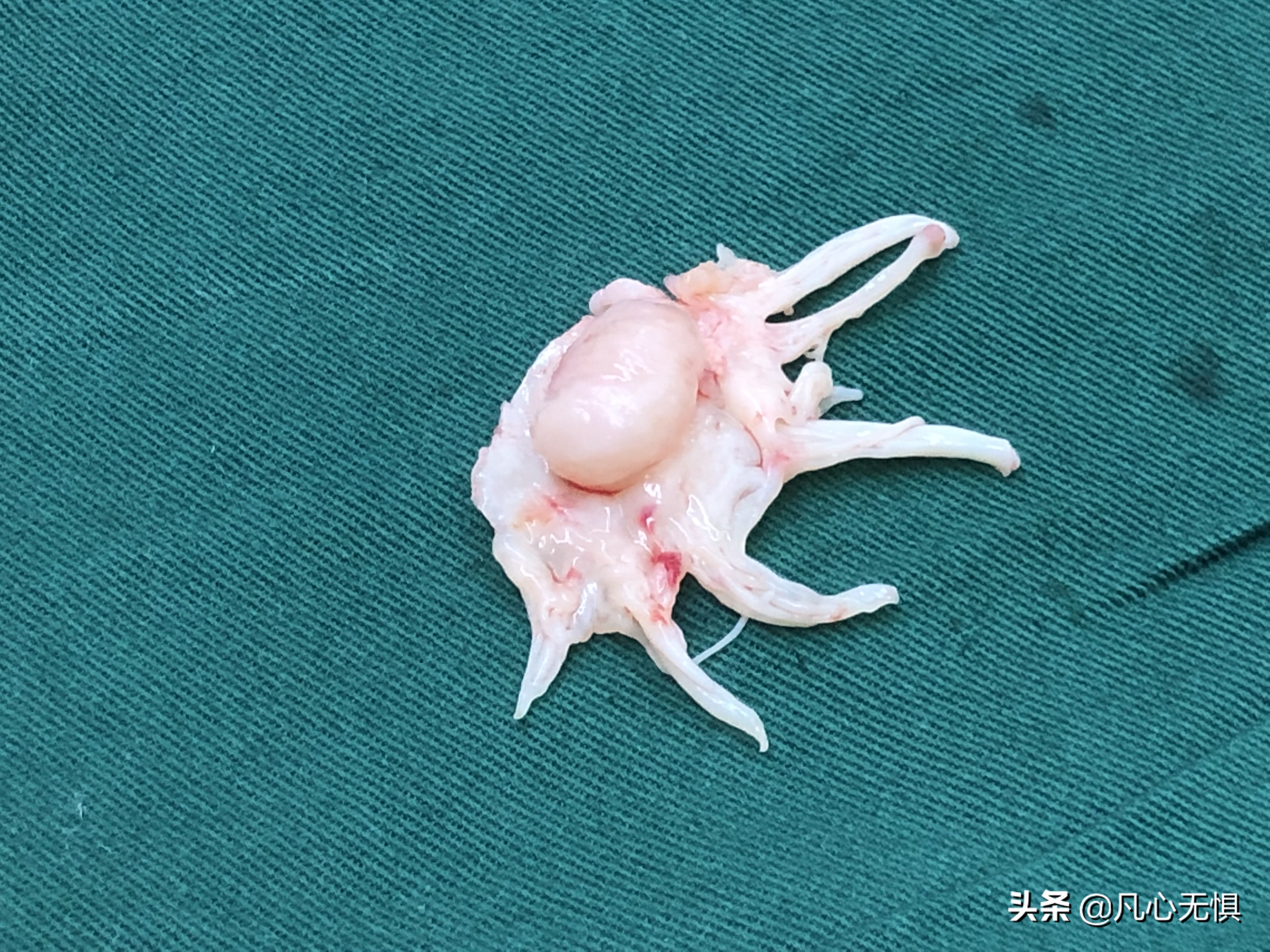 感染性心内膜炎是什么原因引起的,感染性心内膜炎怎么样算控制住了