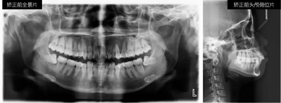 时代天使隐形牙套价格,时代天使隐形牙套能不能戴着吃饭