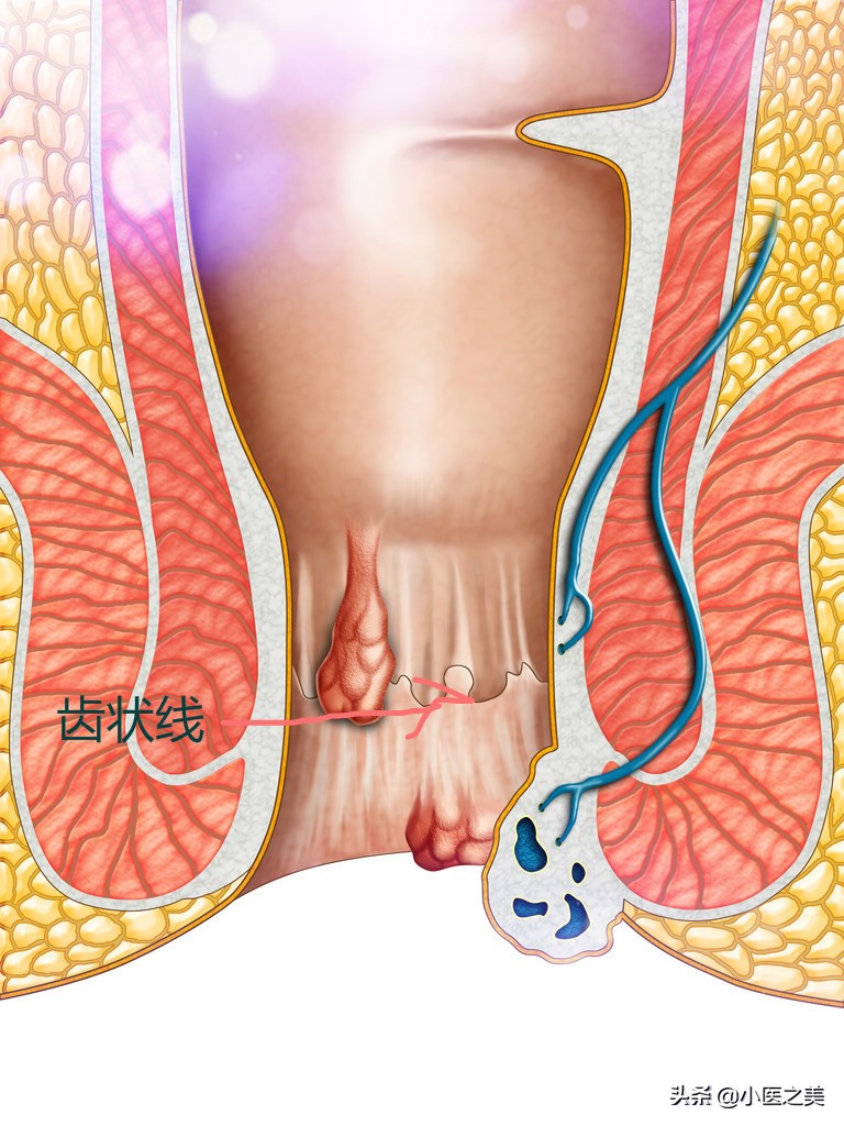 便便后还在滴鲜血,痔疮如何治疗、预防?