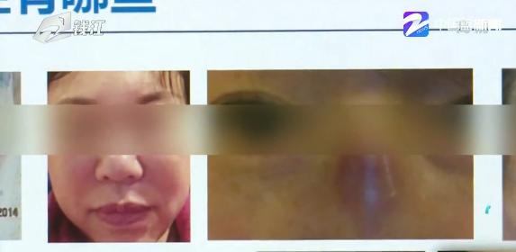 花了四万块整形,花了四万做整形赔了夫人又折兵