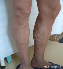 静脉曲张患者预防血栓形成锻炼操,怎样防止静脉曲张血栓