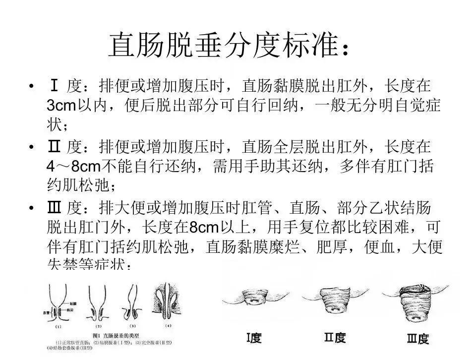 肛门掉东西，竟然是直肠
