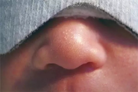 新生儿湿疹又咳嗽,新生儿湿疹每天早上起床加重