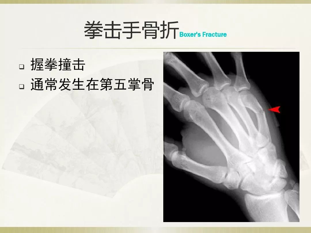 骨科x光片读片技巧,放射科骨科读片教程