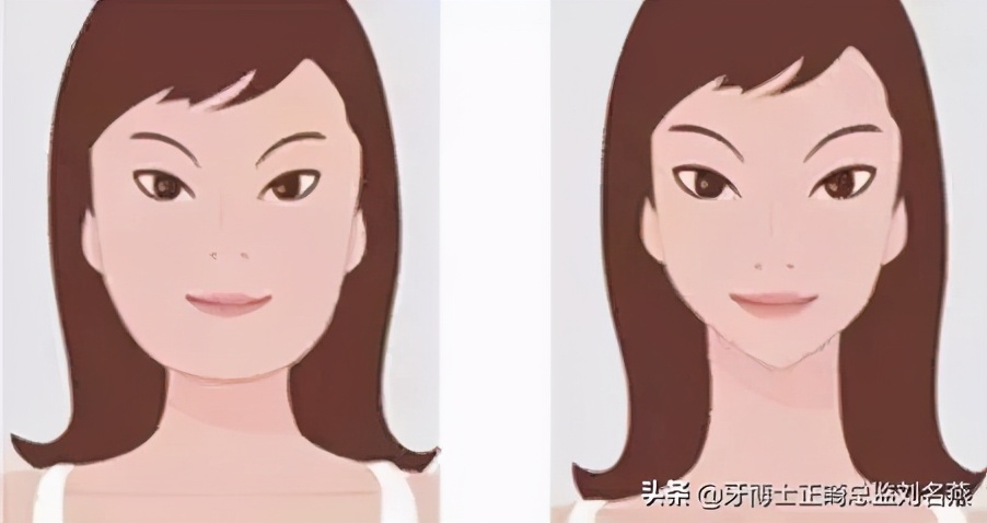 特丑牙齿矫正,牙齿矫正能瘦脸吗