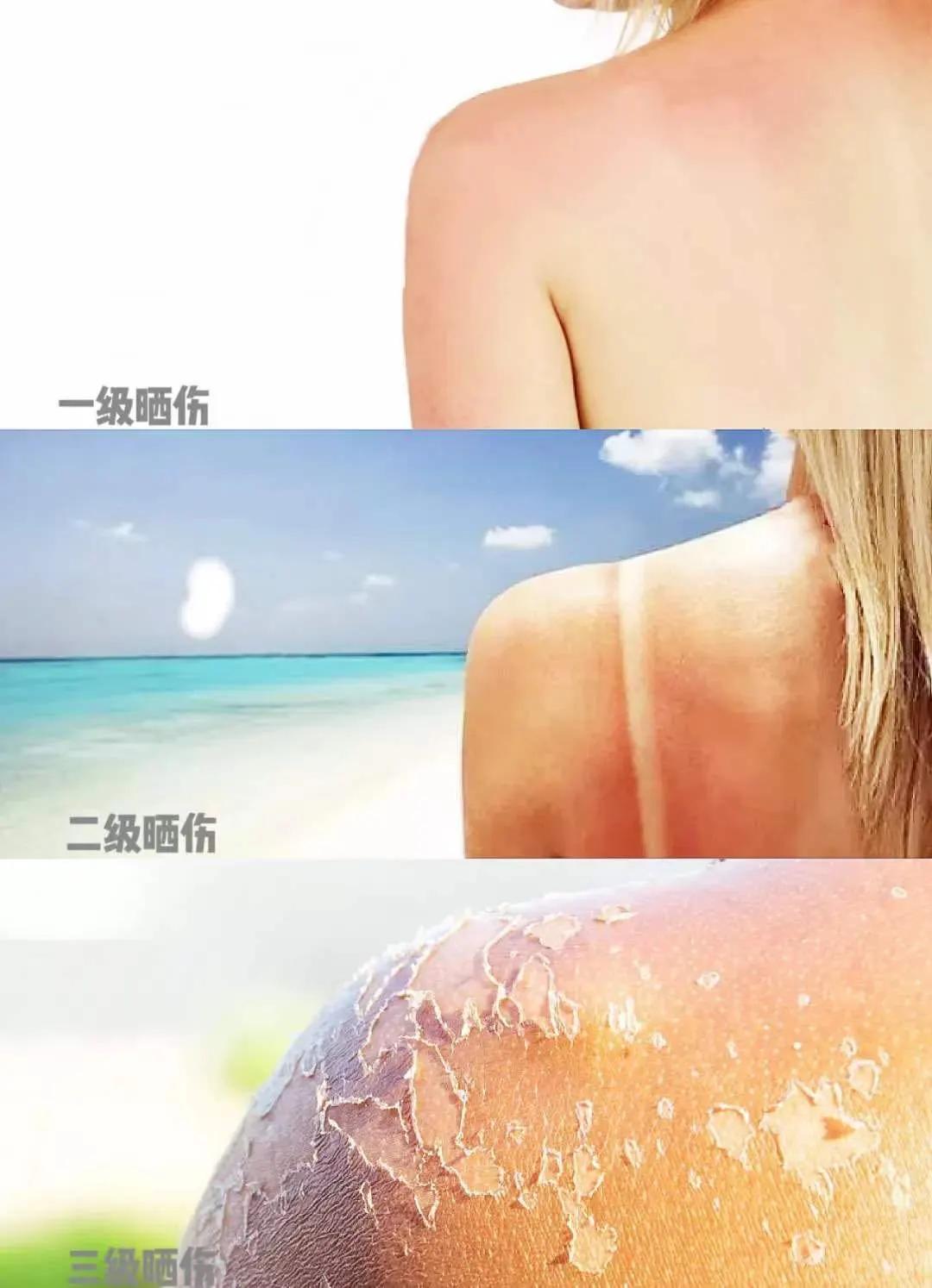 晒黑晒伤不要慌,快准狠修复晒后“关公脸”