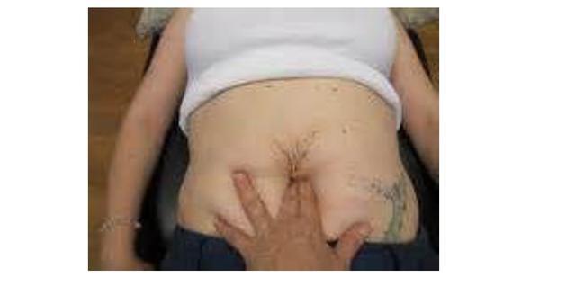 肚子不大就是很松弛怎么办,宝妈腹部松弛下垂可以手术吗