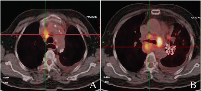 治疗小细胞肺癌的最新方法,小细胞肺癌治疗后成为正常人