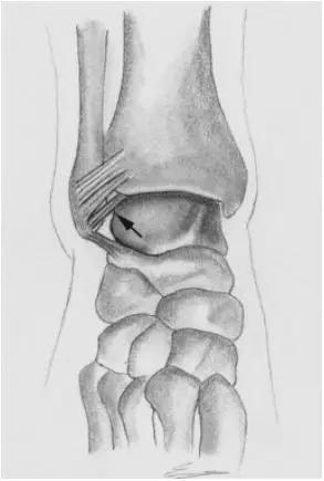 踝关节撞击症问诊,踝关节内侧撞击综合症位置图