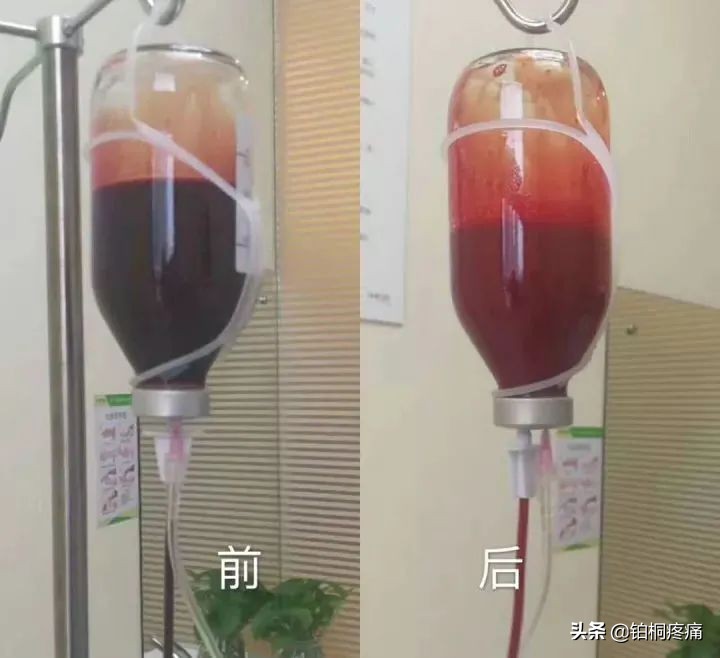 超氧自体血回输疗法是治什么病的,三氧自体血回输疗法简介