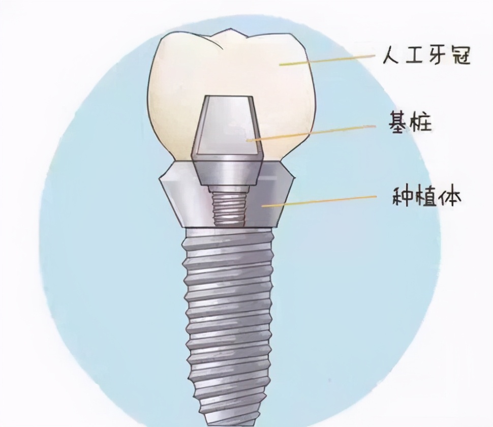 上海雅悦齿科种植牙价格,雅悦齿科医院简介