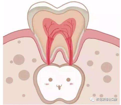 乳牙坏了不用管有恒牙代替对吗,乳牙坏啦不补牙会影响恒牙吗