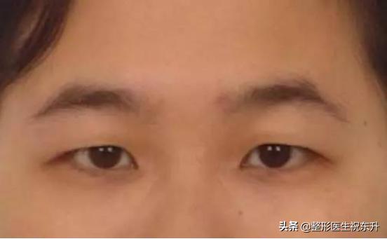 三角眼提眉有后遗症吗,三角眼提眉松弛怎么治