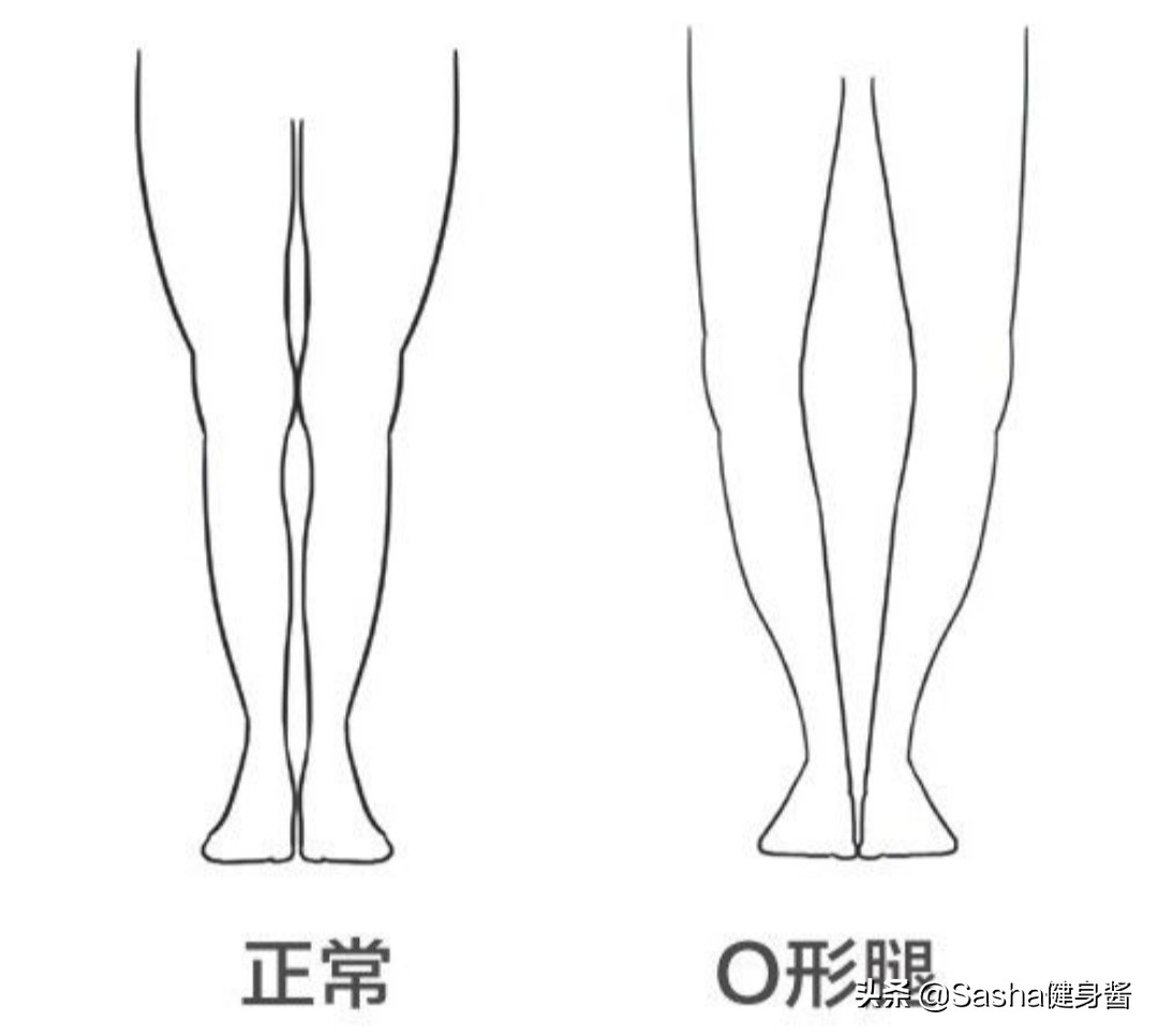 严重o型腿怎么矫正最有效的动作,正确矫正o型腿的方法