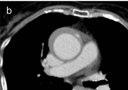 肠系膜上动脉夹层,心脏动脉夹层破裂
