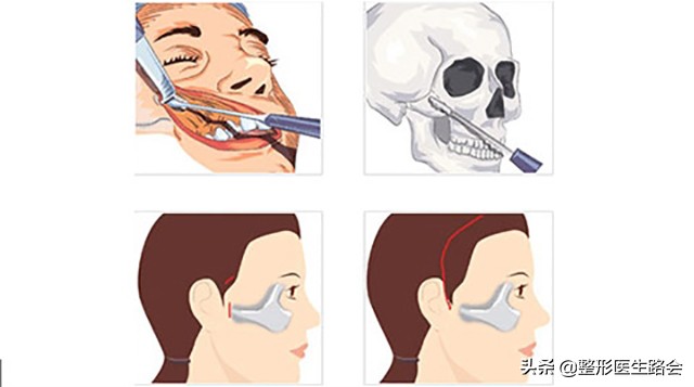 颧骨内推怎么改善脸型,颧骨内推和颧突有什么区别