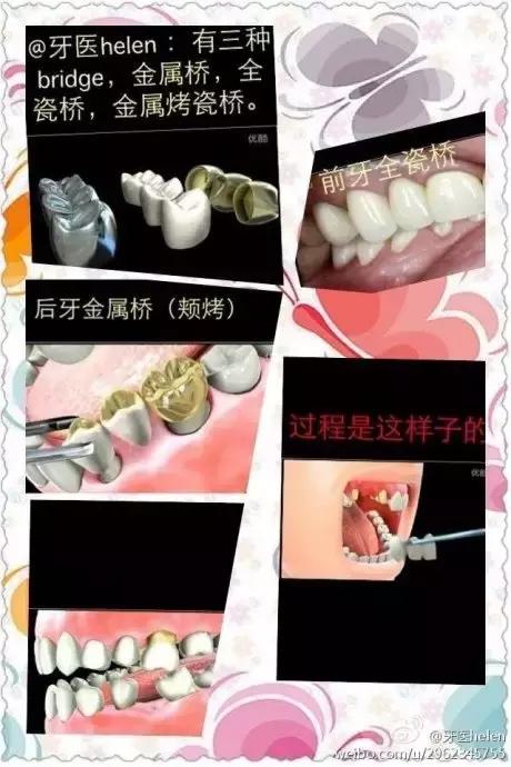 Helen齿科中心——如何选择牙套的材料？！