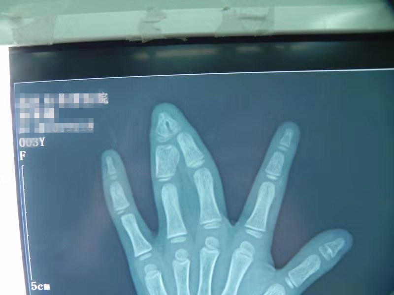 新生儿手指畸形中指食指无名指,婴儿先天性手指畸形中指