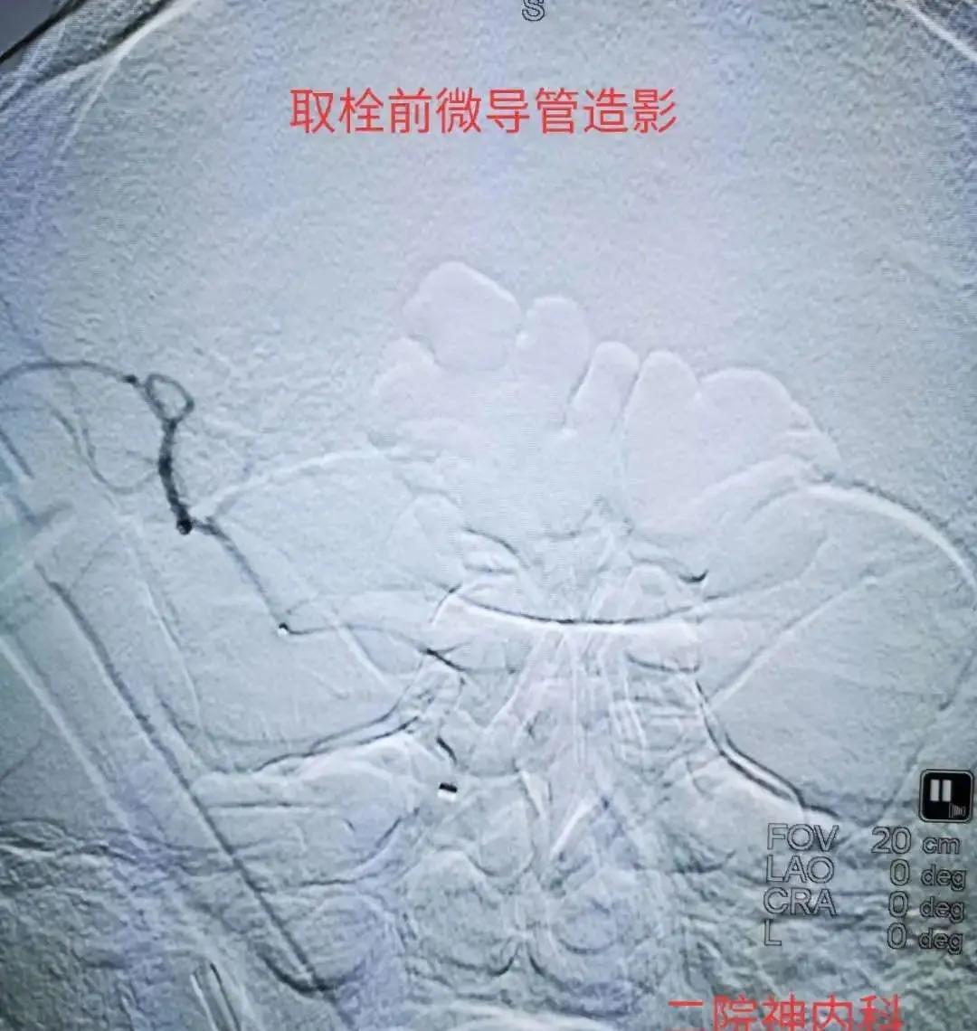 经皮颅内动脉取栓术全过程,为患者打开生命希望之门