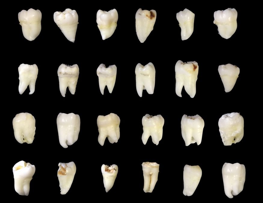埋得越深，分手费越高——你所不知道的拔智齿收费依据
