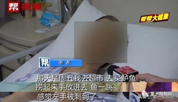 买鱼被鱼刺中截肢,手指被鲈鱼鳍扎伤