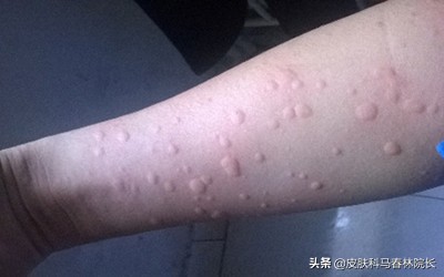 紫癜皮肤病饮食禁忌啥,各种皮肤病患者的饮食禁忌