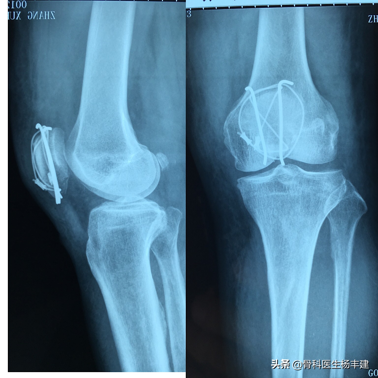 骨折保守治疗一定要手法复位吗,医生科普骨折的视频
