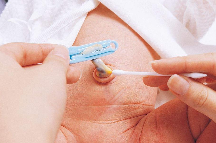 新生儿脐带护理正确的方法,新生儿脐带护理有哪些注意事项