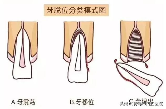 孩子摔断牙不要一扔了之,家长这么做可以让牙齿“起死回生”