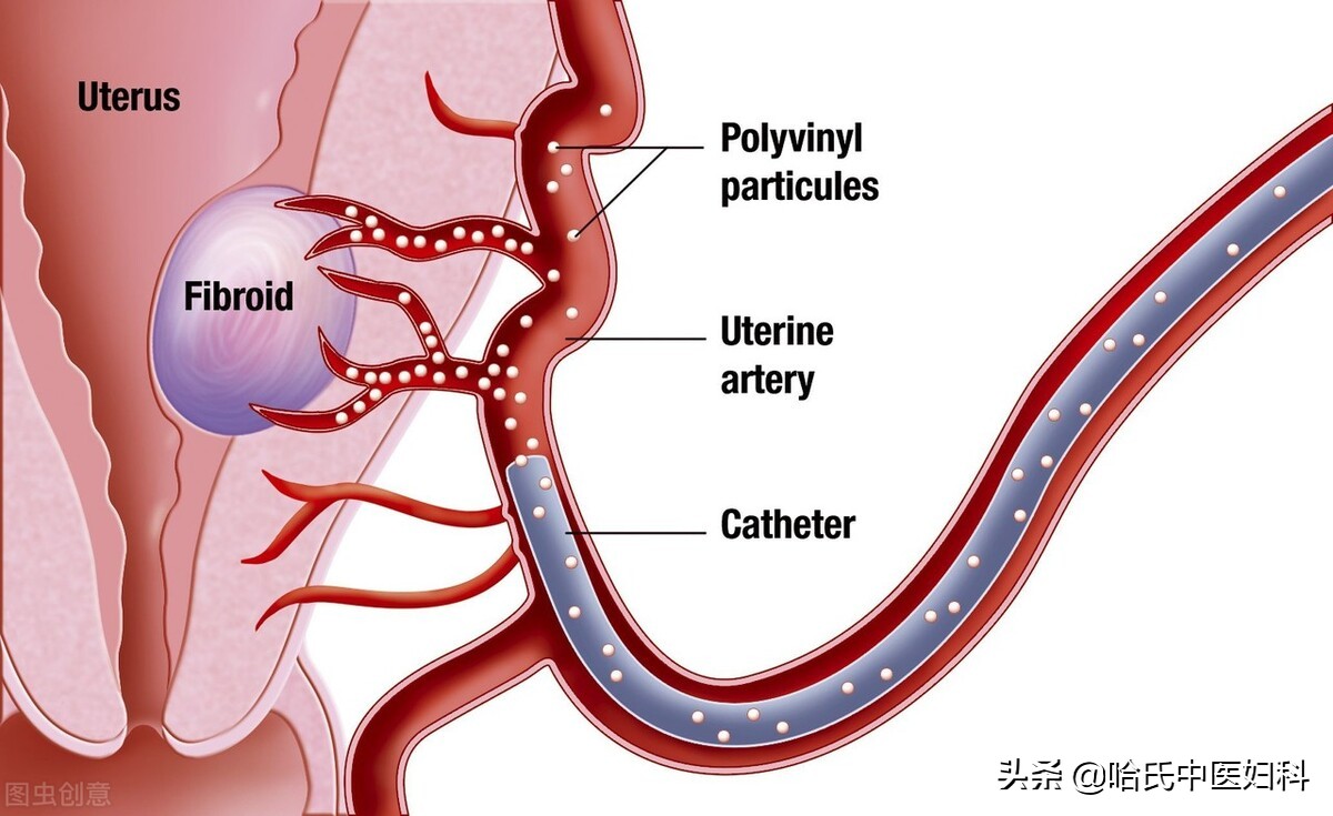 经期能不能做子宫肌瘤,剔除子宫肌瘤三个月能拔牙吗