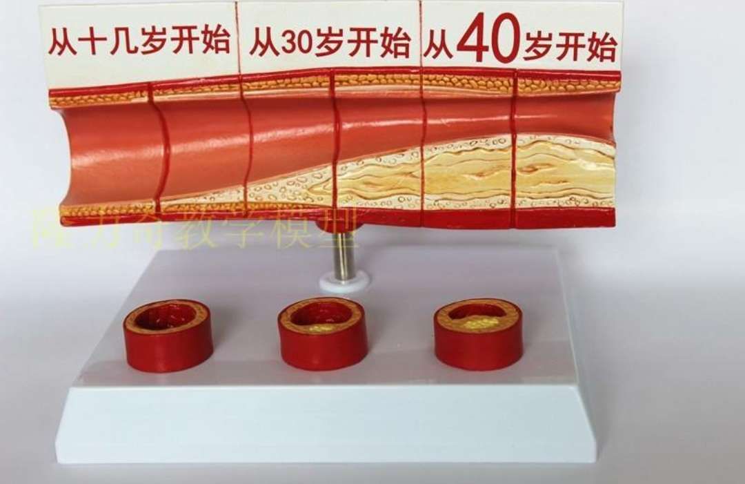 血栓的危害及预防,血栓的危害和预防资料