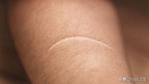 有伤口就会起痘,什么情况会留疤怎么处理