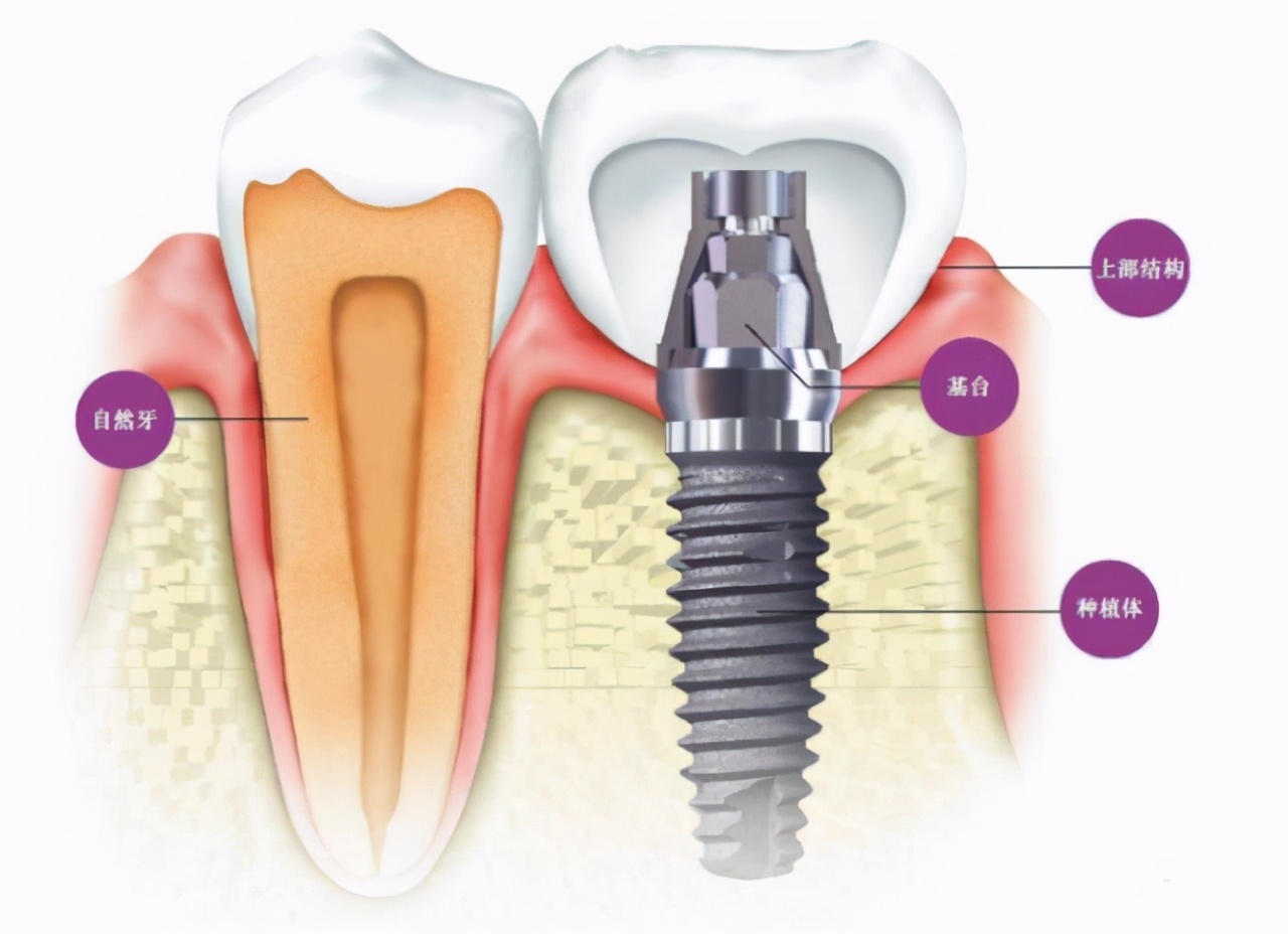 选择一个好的口腔种植牙,口腔种植牙了解一下
