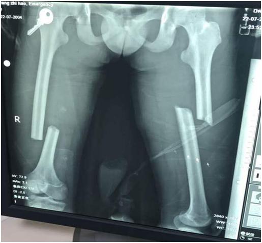 骨折一定要打石膏吗,骨折非要打钢钉吗