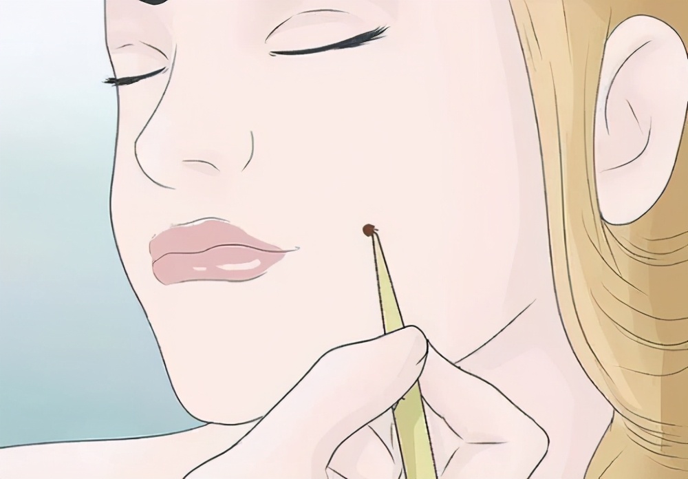 郝医师激光治疗仪有用吗,医生推荐自己点痣最好的方法