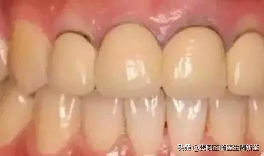 看牙为什么这么贵，牙痛的七个阶段决定你看牙的费用