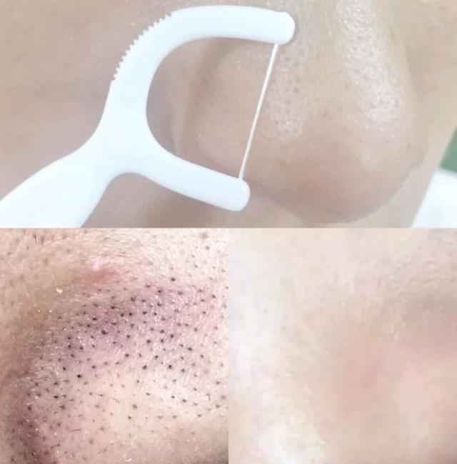 鼻子黑头毛孔粗大怎么去除,鼻子黑头严重毛孔粗大怎么办