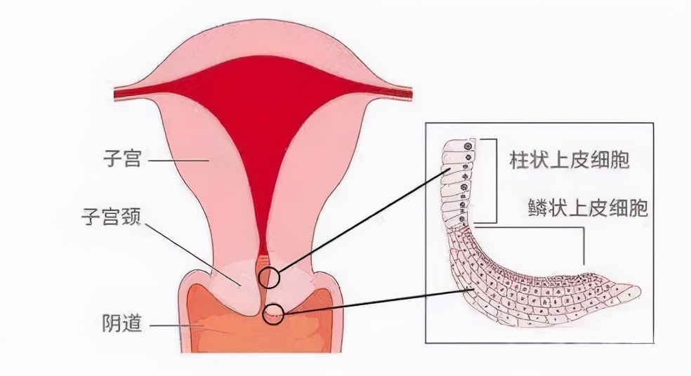 宫颈癌和宫颈糜烂症状一样不,宫颈糜烂与宫颈癌的症状区别