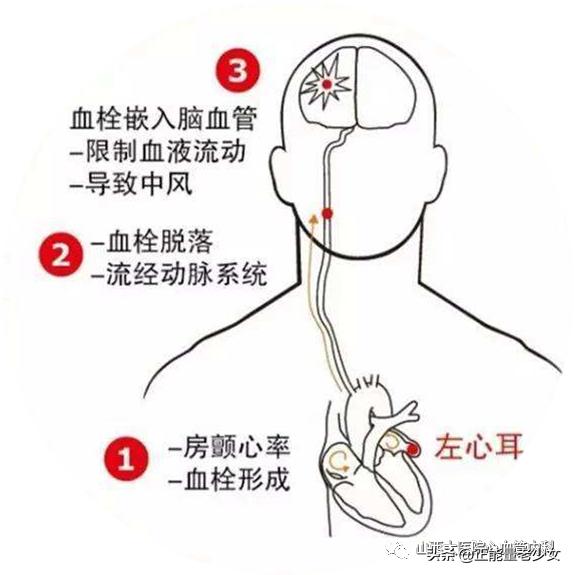 过速性心房颤动,什么是心室颤动