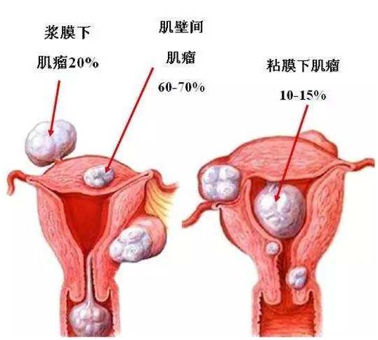 怀疑子宫肌瘤需要做哪些检查,怀疑子宫壁肌瘤