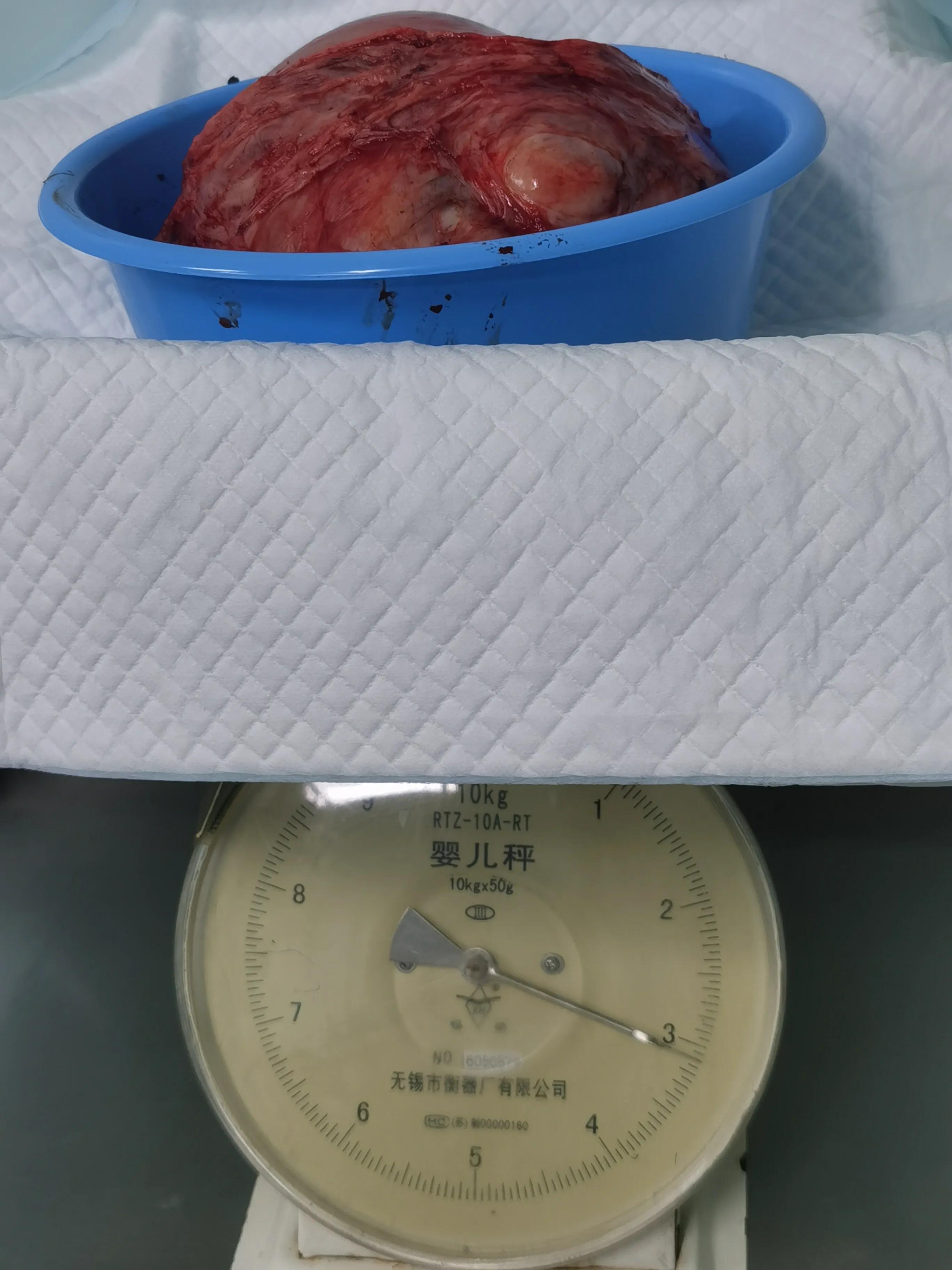 结婚前查出来子宫肌瘤,53岁妇女子宫肌瘤14x12x13mm