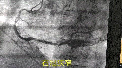 嗓子冒烟咳嗽很长时间也不好,嗓子冒烟儿