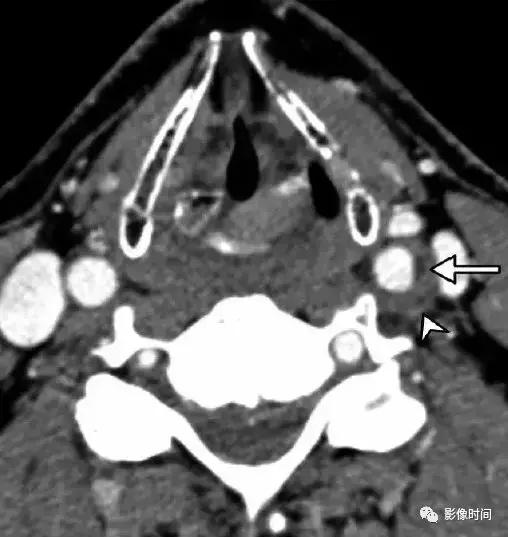 双侧颈动脉鞘间隙多发小淋巴结影,双侧颈动脉间隙多软组织密度结节