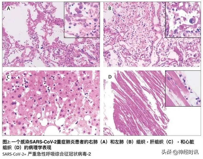 全球新冠肺炎确诊病例统计报告,全世界首例新冠肺炎确诊