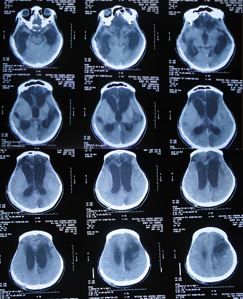 脑受伤开颅手术昏迷,开颅手术后20天发生脑积水引流